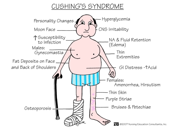 PTA 103 cushings-syndrome.jpg